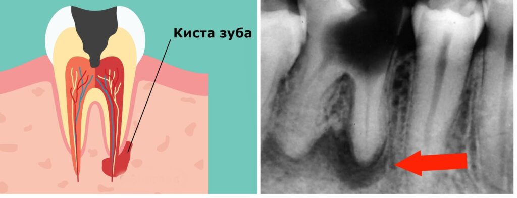 Лечение кисты зуба в Воронеже