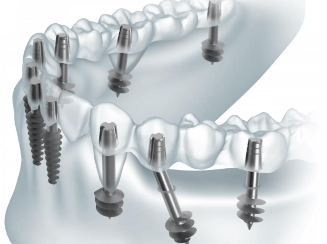 Базальная имплантация: что это такое - Стоматология HOLIDENT
